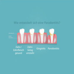 Zahnarzt Dr. Groß Parodontologie_2