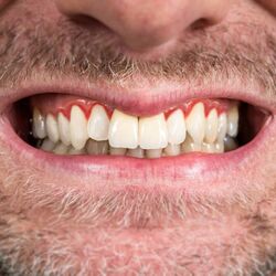 Zahnarzt Dr. Groß Parodontologie_1