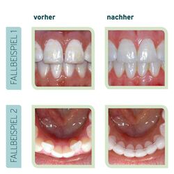 CA® CLEAR ALIGNER Fälle